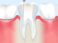歯の根の治療～根管（こんかん）治療～