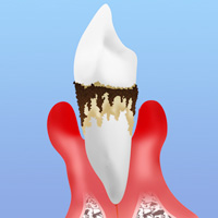 歯ぐきの治療