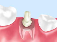 歯の土台の構築