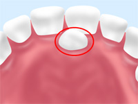 過剰歯の抜歯